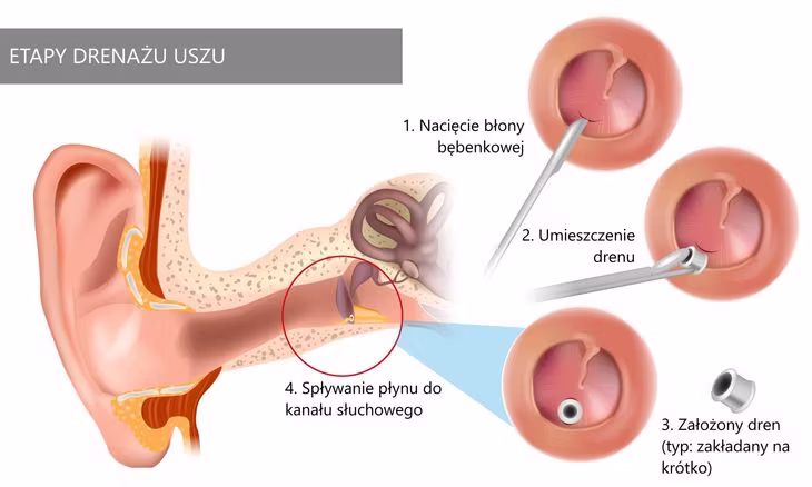 Drenaż uszu u laryngologa: lekarz oczyszcza przewód słuchowy, lekko nacina błonę bebenkową, zakłada niewielką, bardzo krótką rurkę w błonie. Fot. Adobe Stock.
